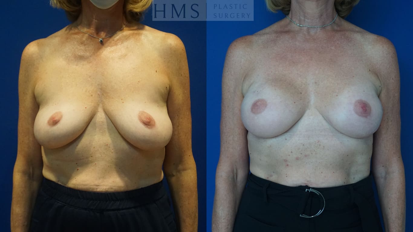 before and after Breast Reconstruction procedure