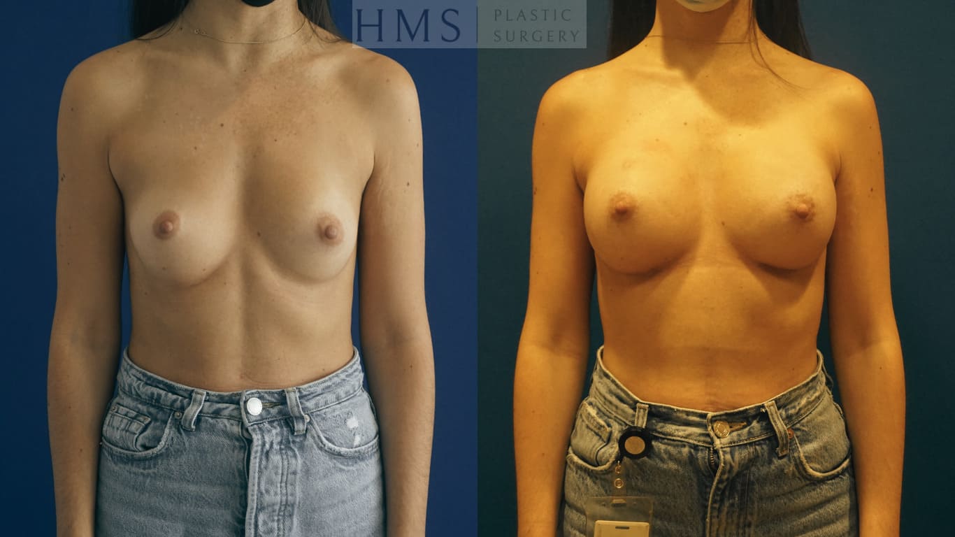 before and after Breast Augmentation procedure