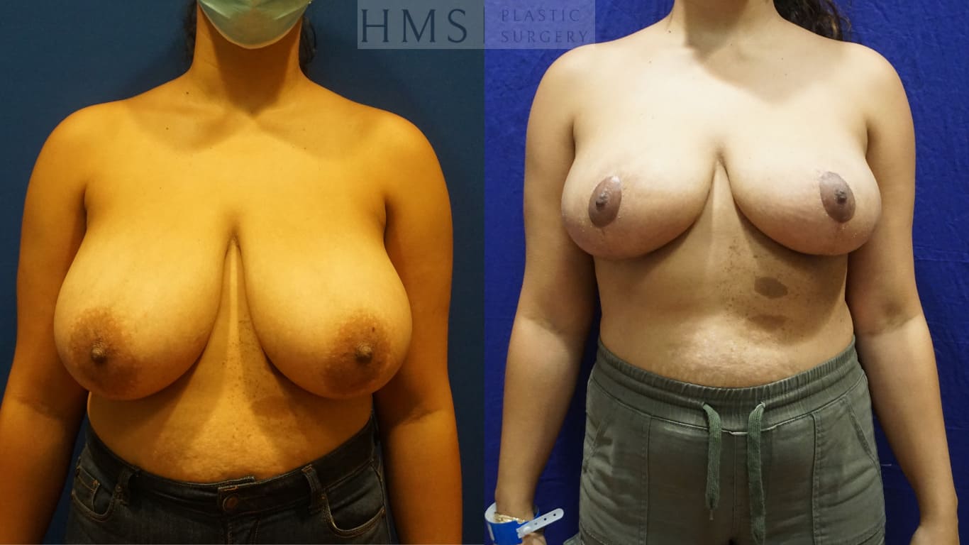 before and after Breast Reduction procedure