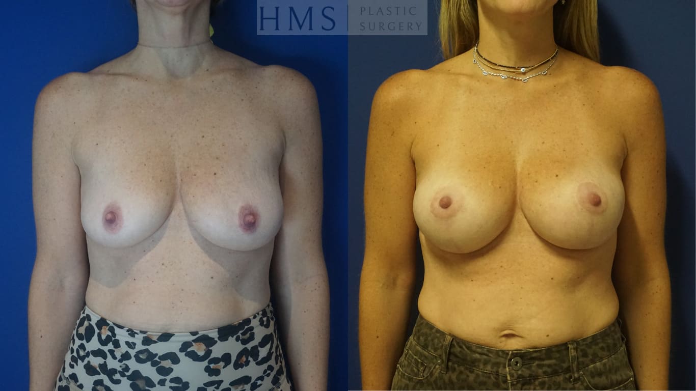 before and after Augmentation Mastopexy procedure