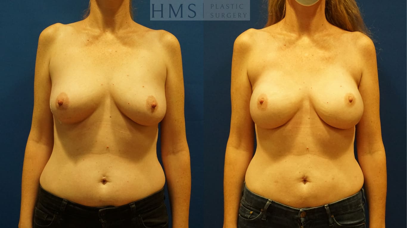 before and after Breast Reconstruction procedure