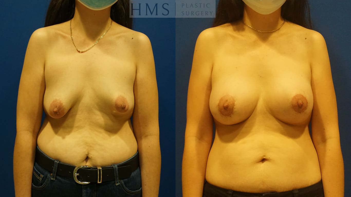 before and after Augmentation Mastopexy procedure