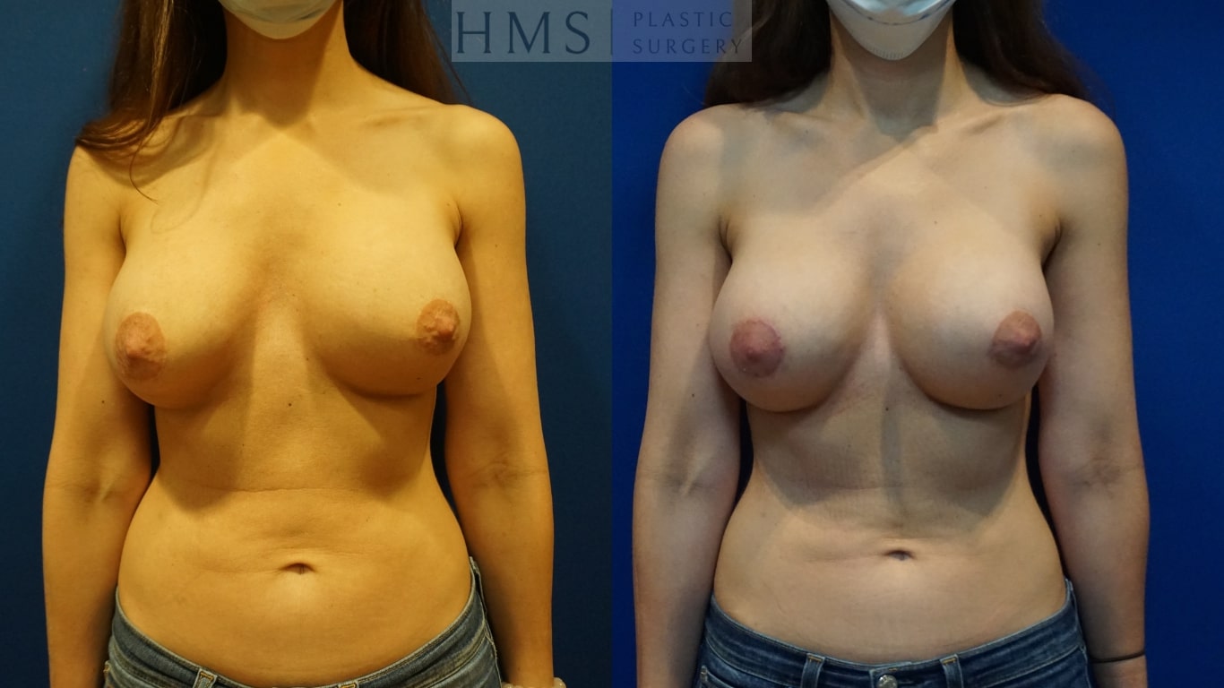 before and after Breast aesthetic procedure