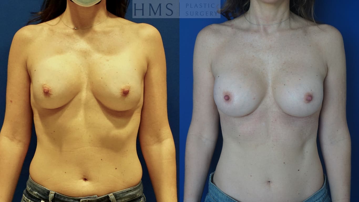 before and after Breast Aesthetic procedure
