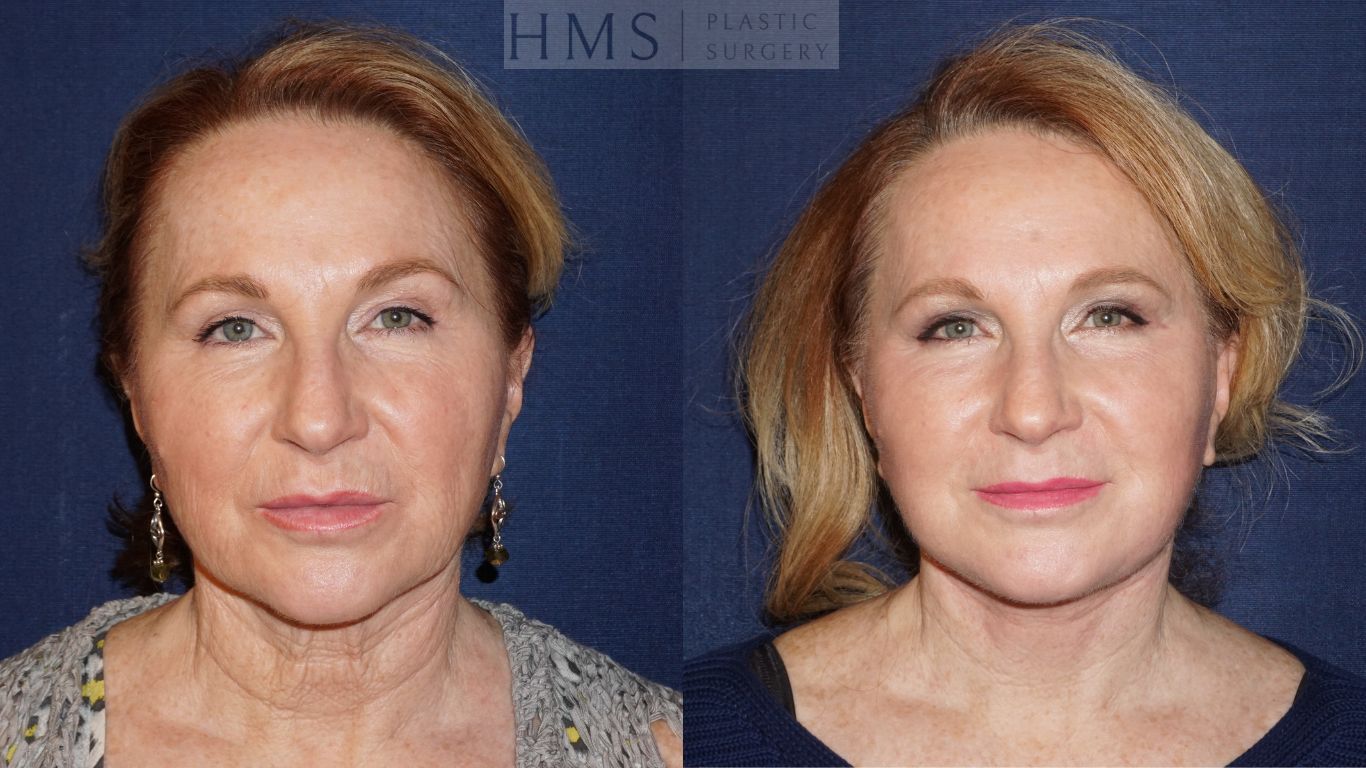 Before and after photos of a 65 year old female after Face and neck lift and TCA peel of upper lip