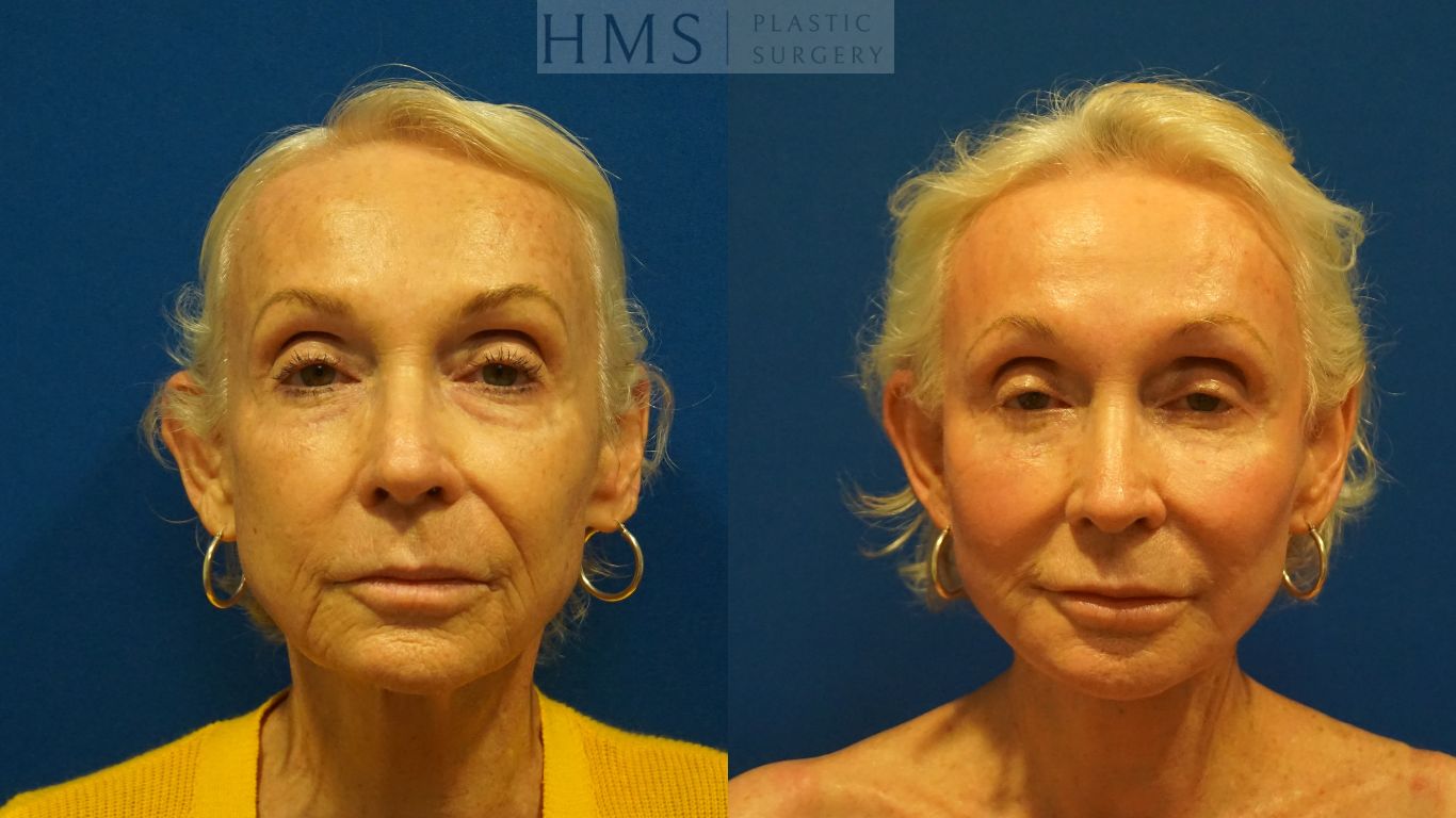 Before and after photos of a 73 year old female after Face and neck lift and Lower blepharoplasty