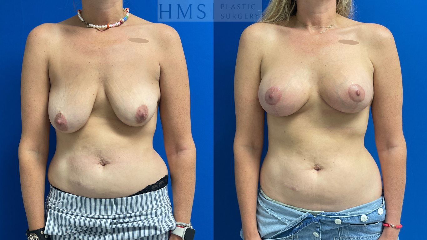 Before and after photos of a 40 yo female after Bilateral augmentation and mastopexy