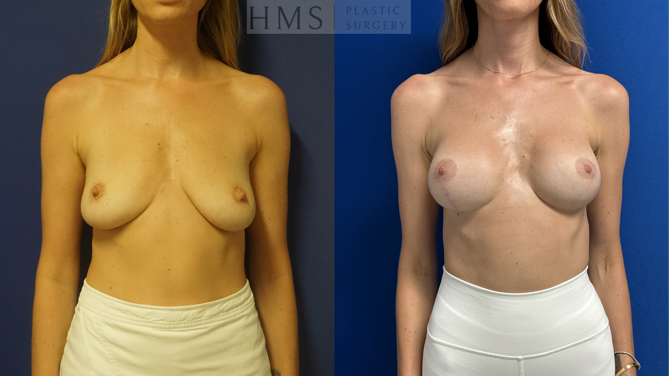 Before and after photos of a 34 yo female after Bilateral augmentation and mastopexy