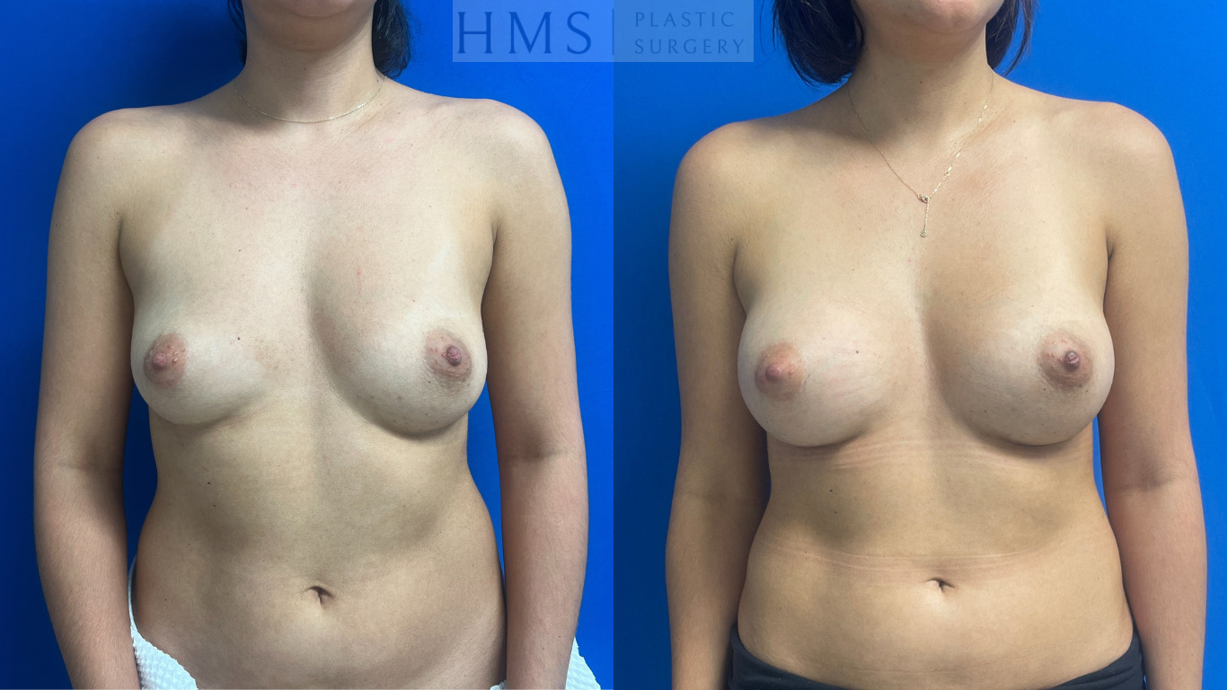 Before and after photos of a 40 yo female after Bilateral breast augmentation