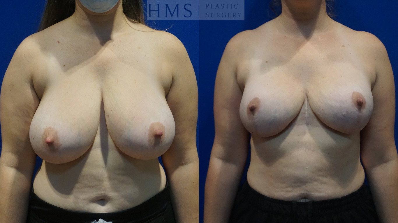 Before and after photos of a 38 yo female after Breast reconstruction