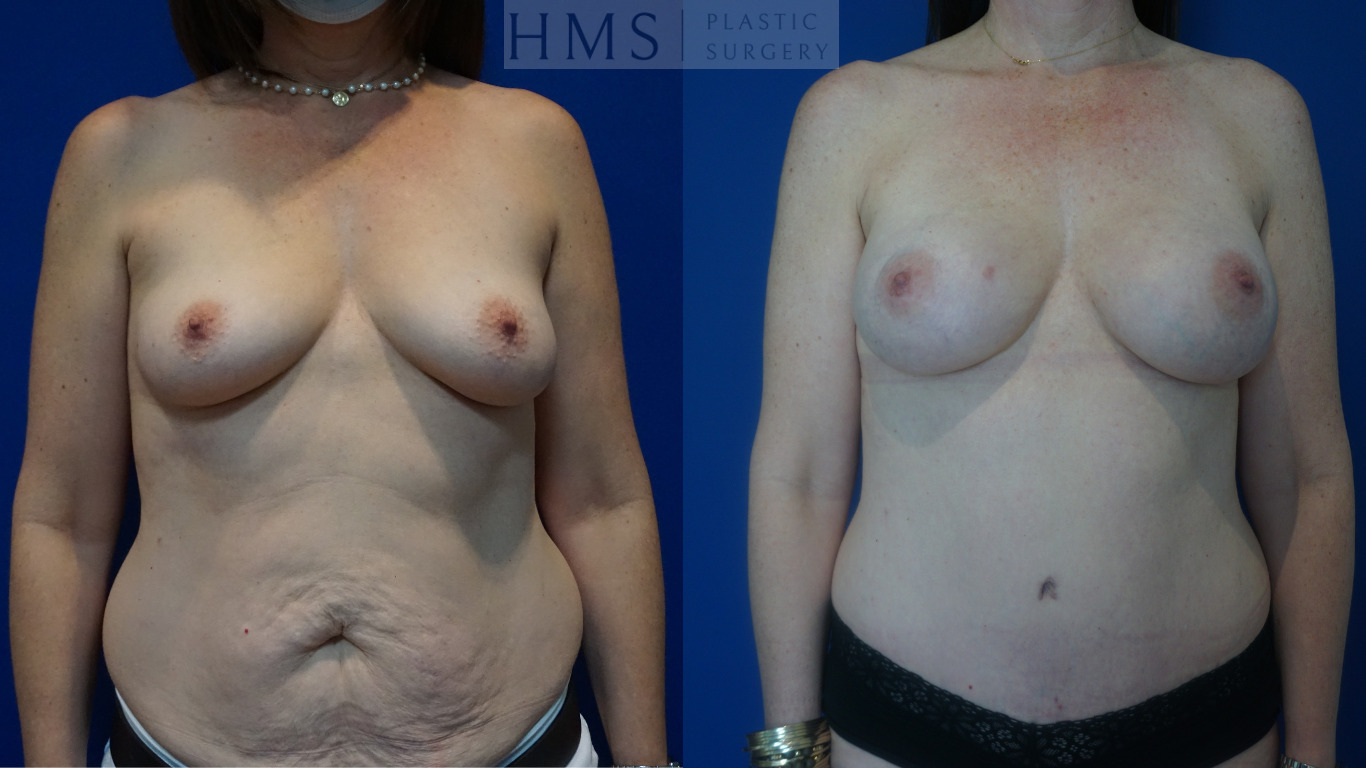 Before and after photos of female after Abdominoplasty