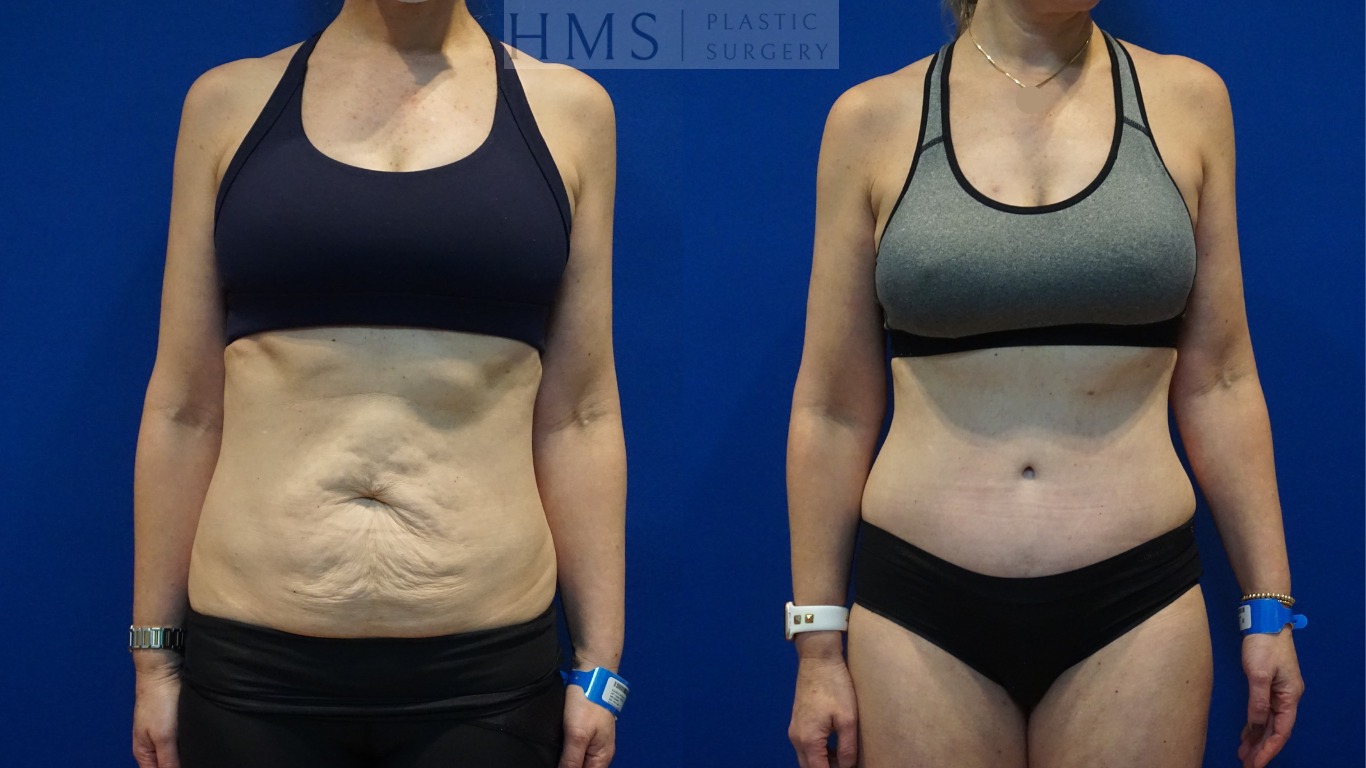 Before and after photos of female after Abdominoplasty