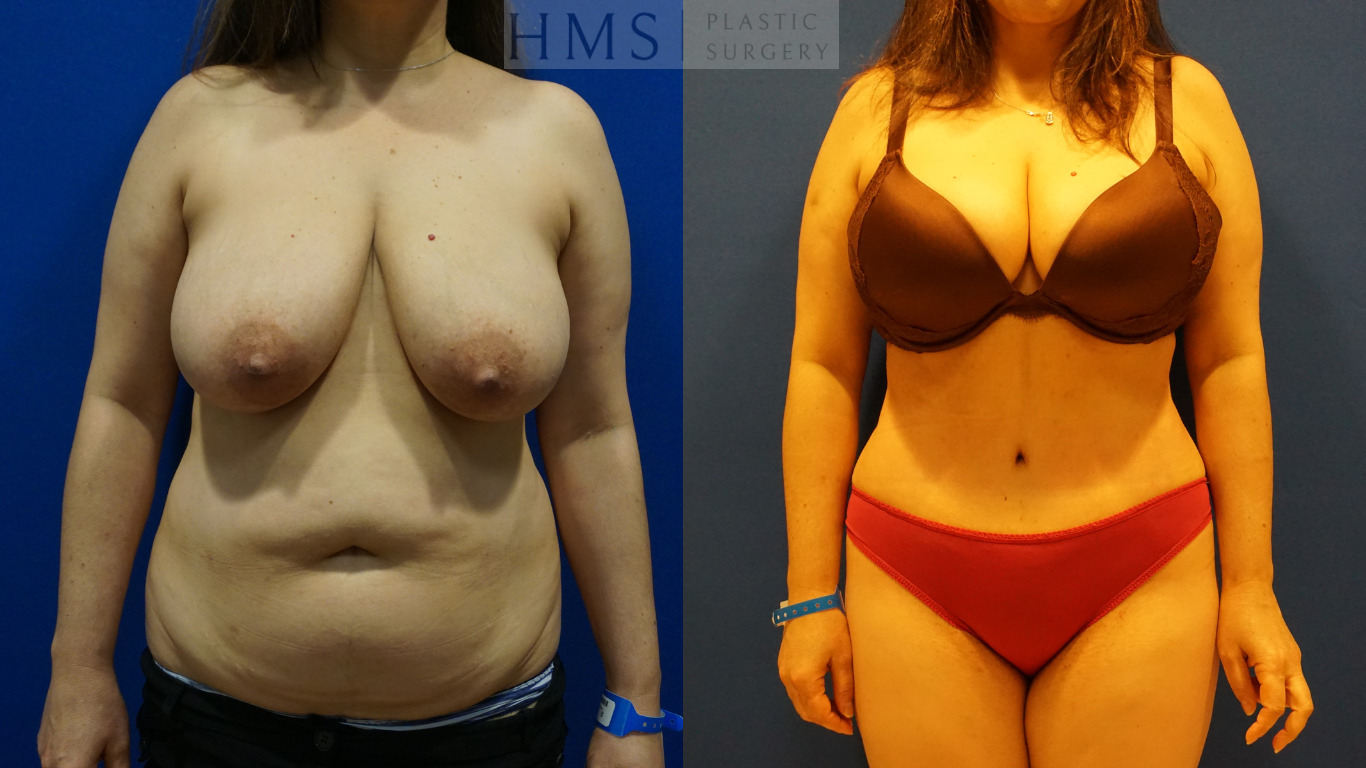 Before and after photos of female after Abdominoplasty