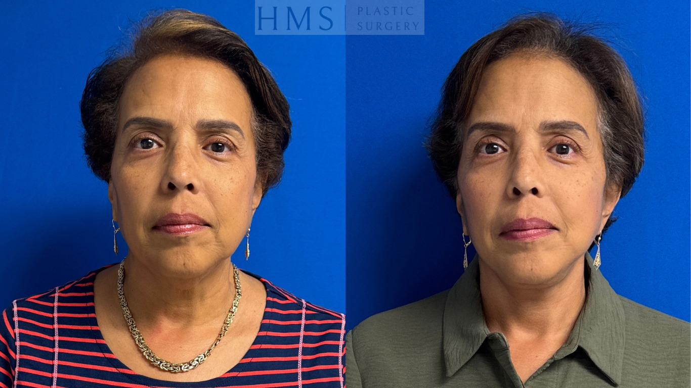 Before and after photos of a 60 year old female after Face and neck lift